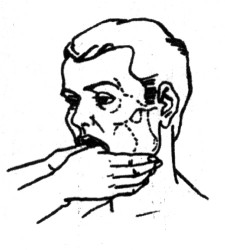 Лечение вывиха нижней челюсти Лечение вывиха нижней челюсти