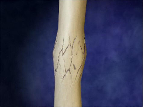 Причины возникновения костной мозоли Причины возникновения костной мозоли