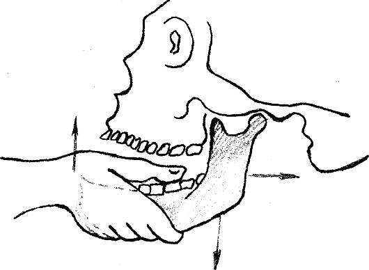 Вправляем передний вывих челюсти Вправляем передний вывих челюсти