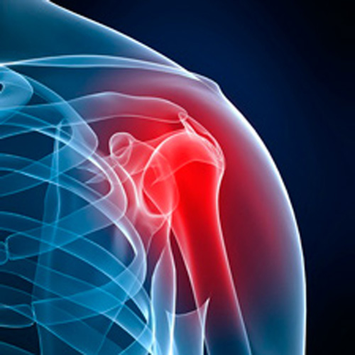 Вывих плечевого сустава Вывих плечевого сустава