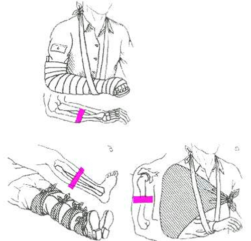 Закрытый перелом и способы его лечения 4 лечение закрытого перелома