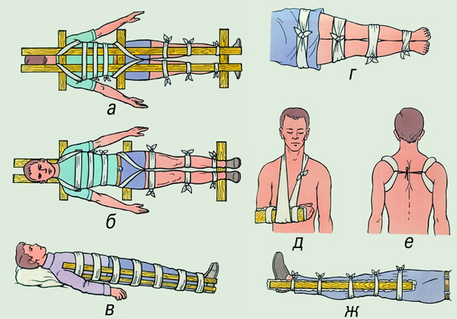 Закрытый перелом и способы его лечения 3 помощь при закрытом переломе